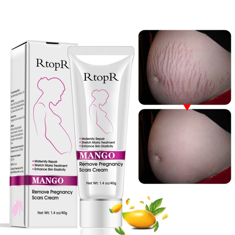 Mango Stretch Mark Cream Natural Mild Non-irritating for Remove Pregnancy Scars Acne Cream Repair Anti-Aging Anti Winkles