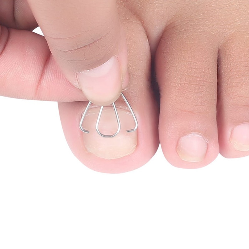 Nail Art Ingrown Toe Nail Correction Tool Toenail Nail Orthosis Paronychia Clip