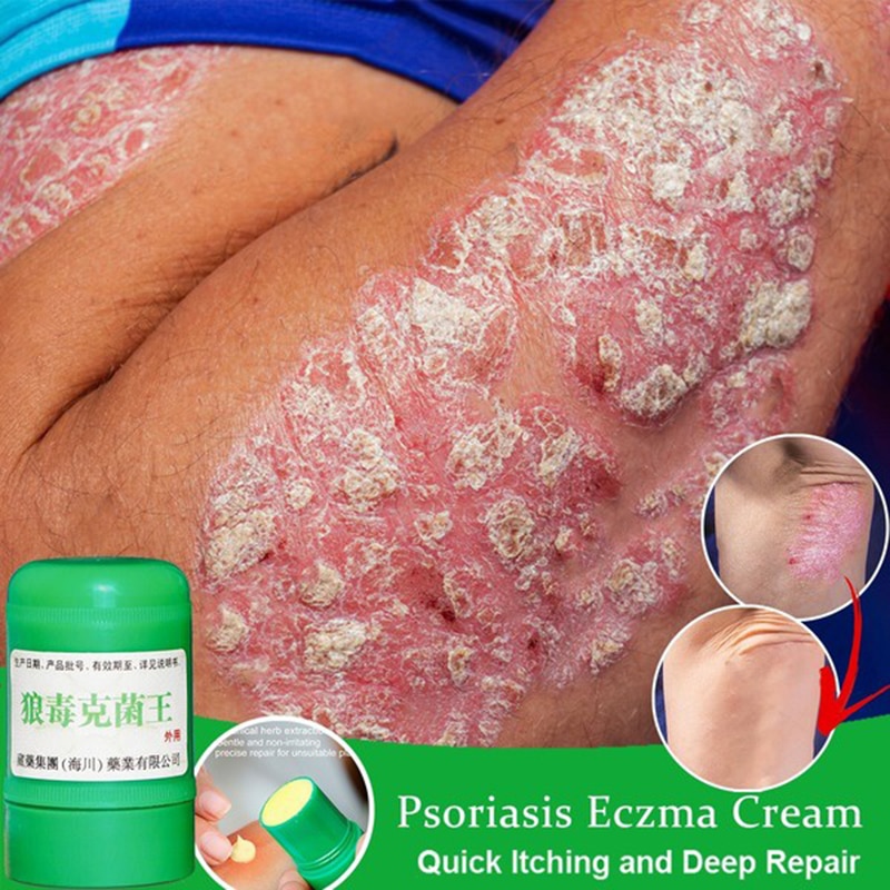 Skin Psoriasis Cream For Skin Problems’ Chinese Herbal Antibacterial Ointment