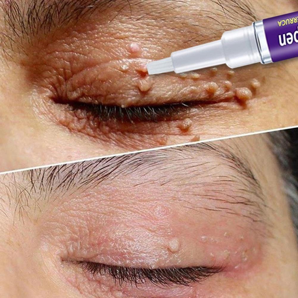 Removal Genital Wart Treatment Papillomas Skin Tags Removing Against Moles Remover Anti Rapidly Effective Verruca Remedy