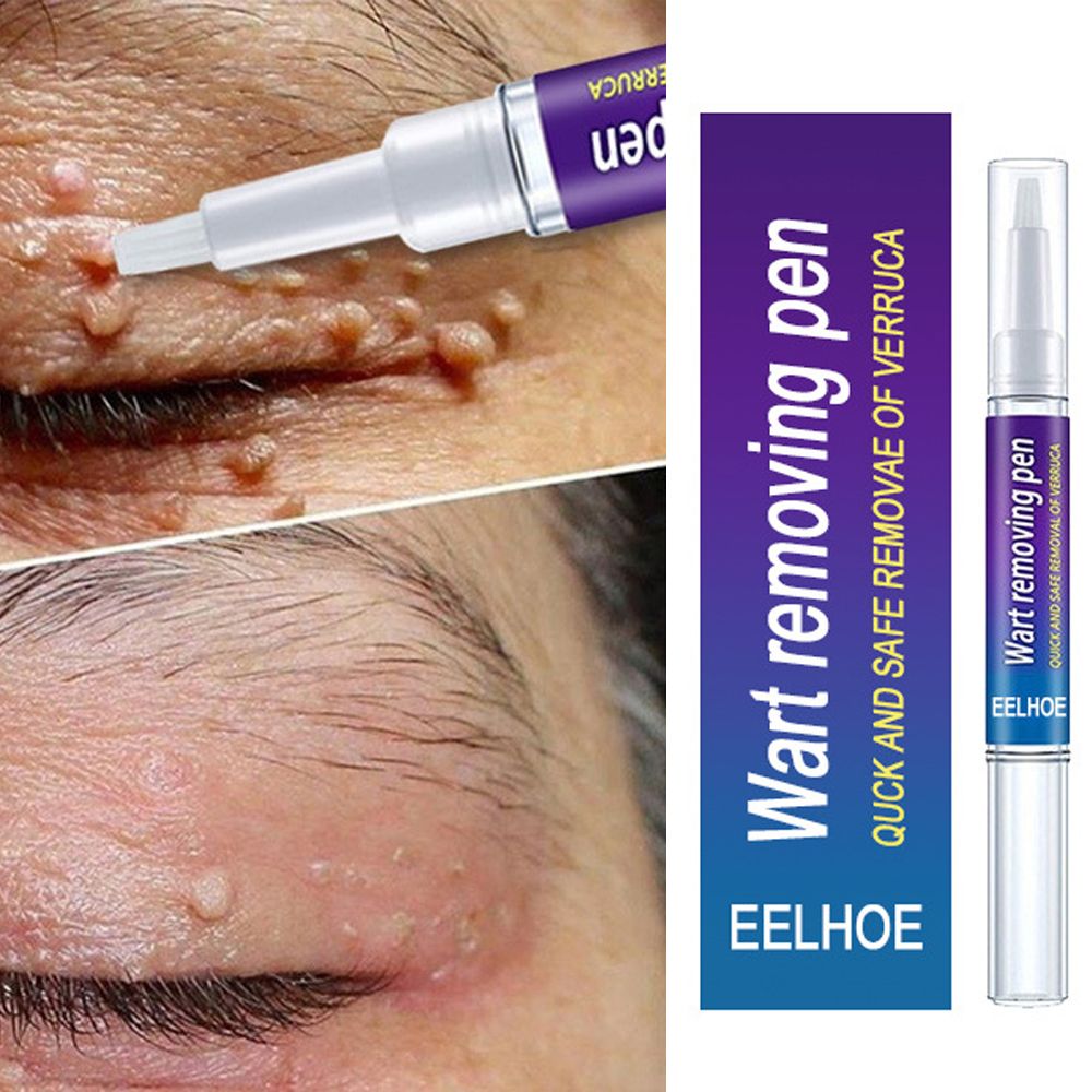 Beauty Health Skin Care Removal Of Warts Liquid Warts Remover Pen Removing Against Moles Anti Verruca Remedy