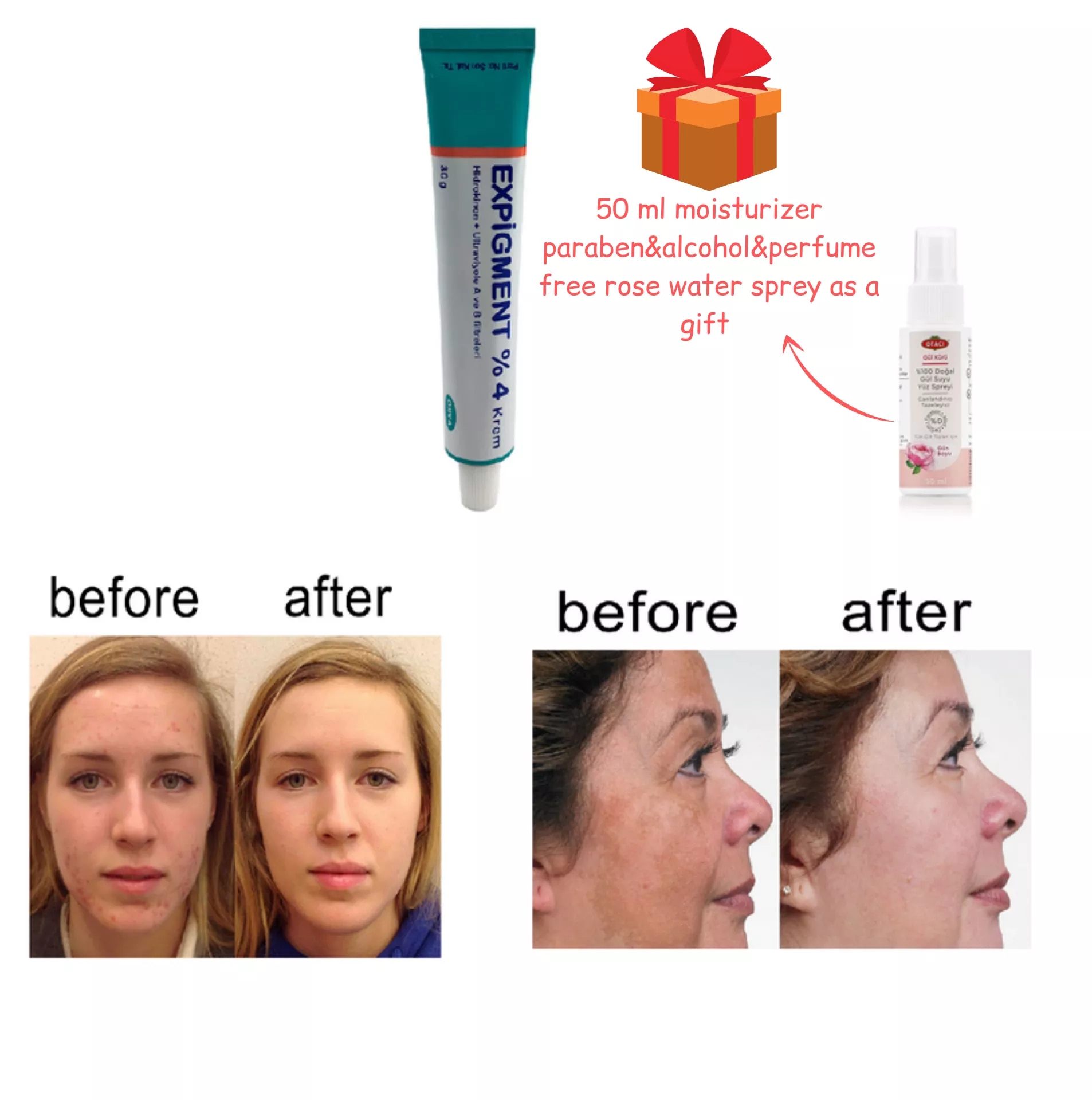 Expigment hidrokinon yüz ve cilt akne tedavisi ince kırışıklıklar cilt beyazlatma cilt aydınlatma % 100 Original