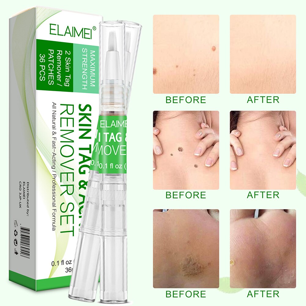 Remove Against Moles Remover Anti Wart Remedy Liquid Pen Treatment Papillomas Removing Warts Liquid From Skin Tags Repair