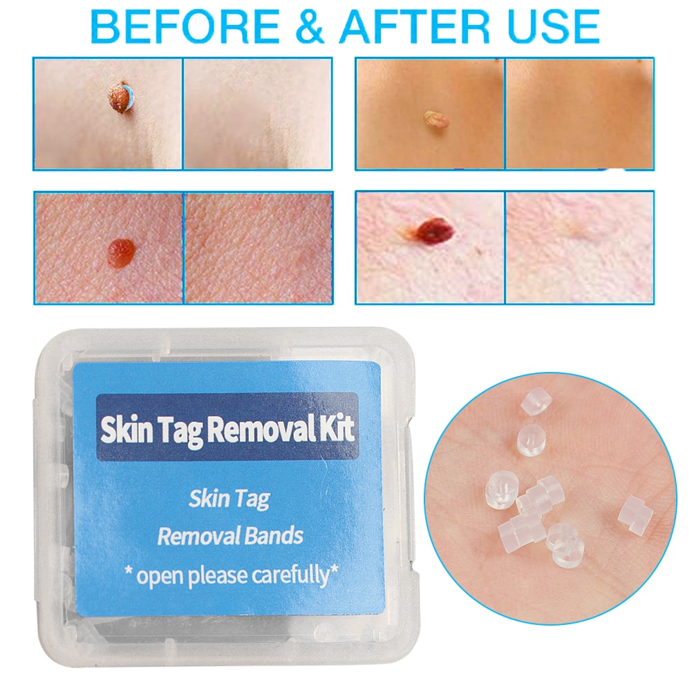 30Pcs High Quality Skin Tag Removal Rubber Bands Micro Band Non Toxic Face Care Mole Wart Acne Pimple Blemish Treatment Tools