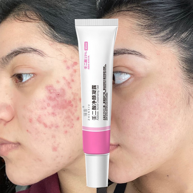 Azelaic Acid Cleansing Gel Acne Removal Acne Closure Blackhead Shrink Pore Fade Acne Marks Cleansing Gel