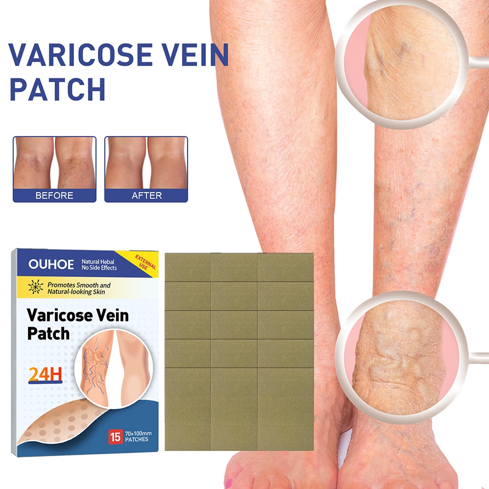15pcs Leg Varicose Veins Patch Leg Vasculitis Phlebitis Spider Anti-swelling Angiitis Removal Chinese Medical Leg Care Plasters