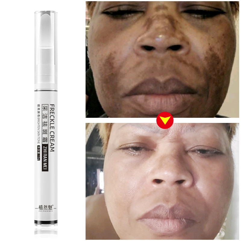 Whitening Freckles Cream Remove Dark Spot Pen Lightening Melanin Removal Melasma Remover Moisturize Brighten Face Gel Skin Care