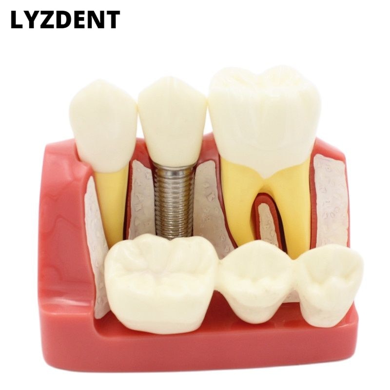 LYZDENT Dental Teach Implant Analysis Crown Bridge Removable Model Dental Demonstration Tool