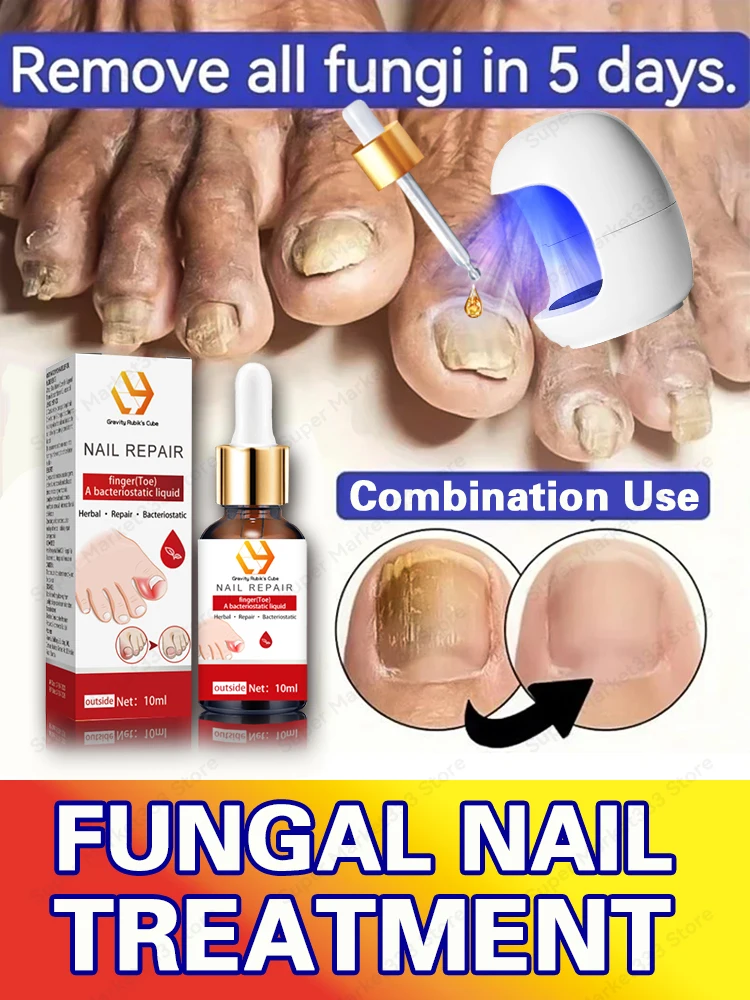 Laser Product For Solving Nail Problems