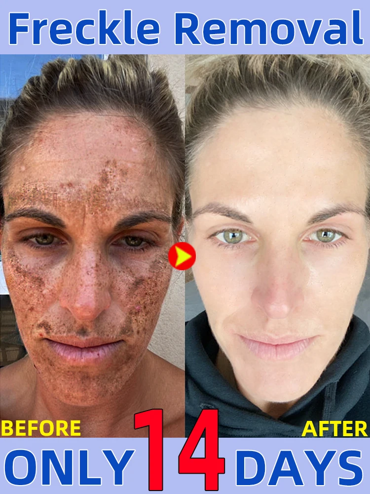 Freckles Chloasma Dark Sun Age Spot Clear