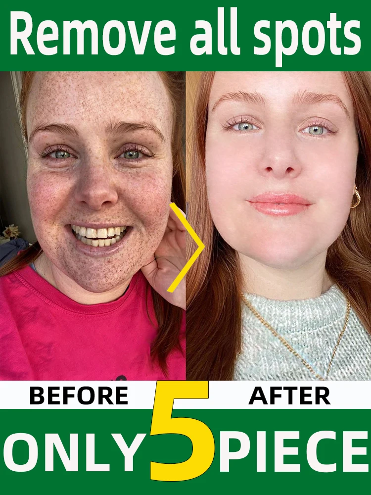 Age Sun Dark Spot Freckles Clear
