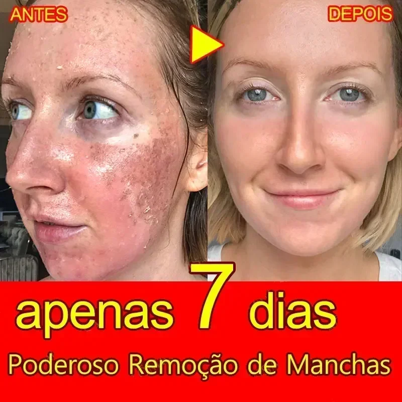 Freckles Removal Cream Remove Skin Dark Spot Melasma Age Spots Sunspots Whitening And Freckle Removing Cream