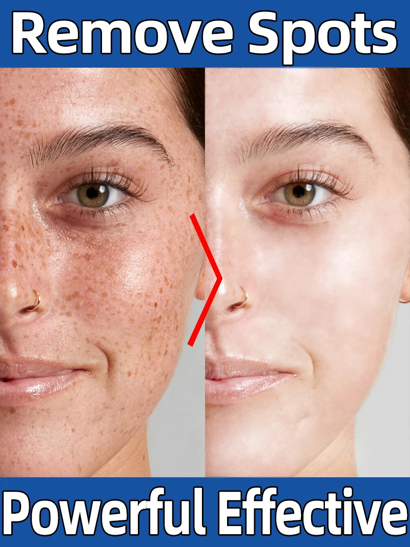 Freckles Dark Age Sun Spot Diminish