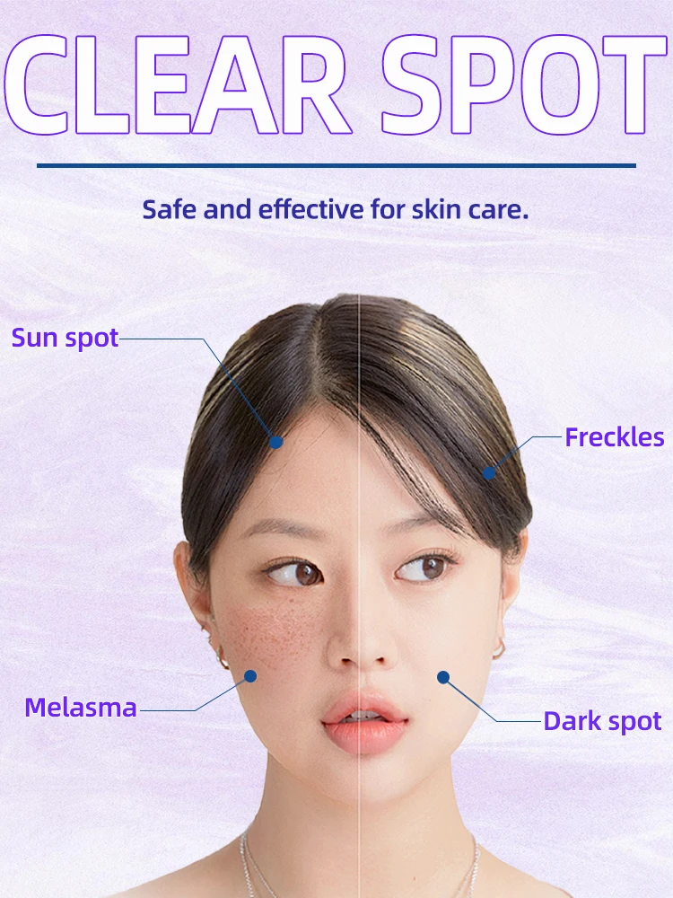 Chloasma Freckles Age Sun Dark Spot Diminish