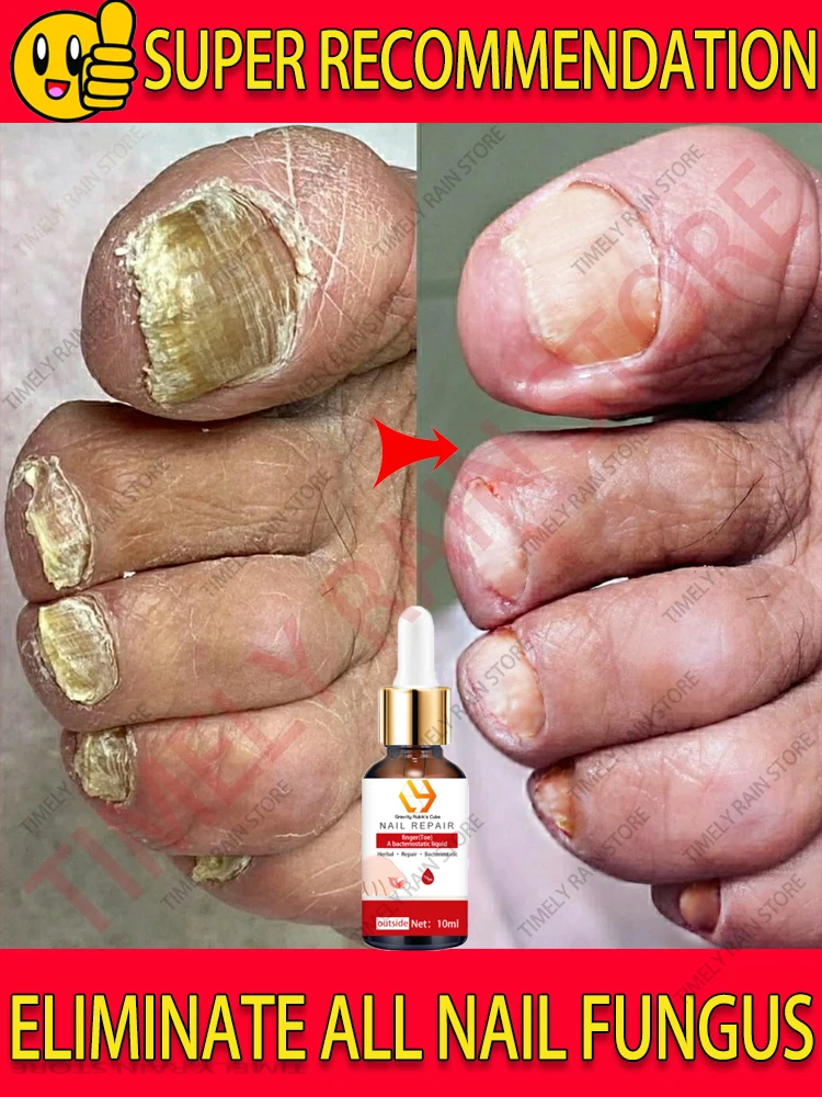 Laser Product To Solves Nail troubles