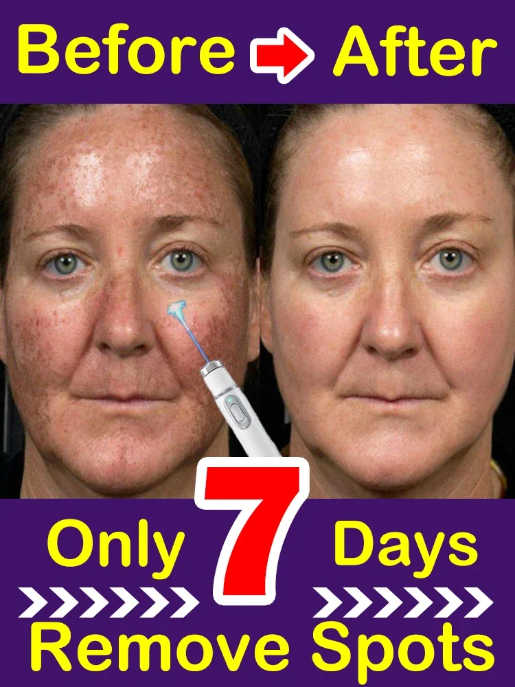 Sun Dark Age Spot Freckles Clear