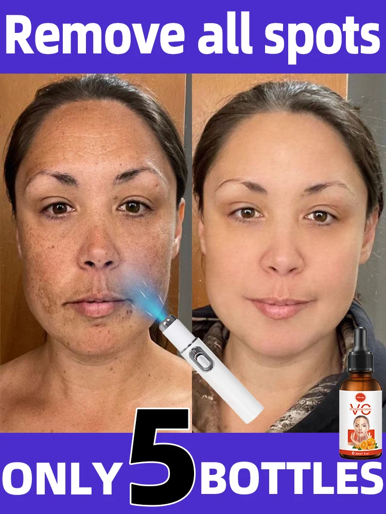 Clear Dark Sun Age Spot Freckles Chloasma