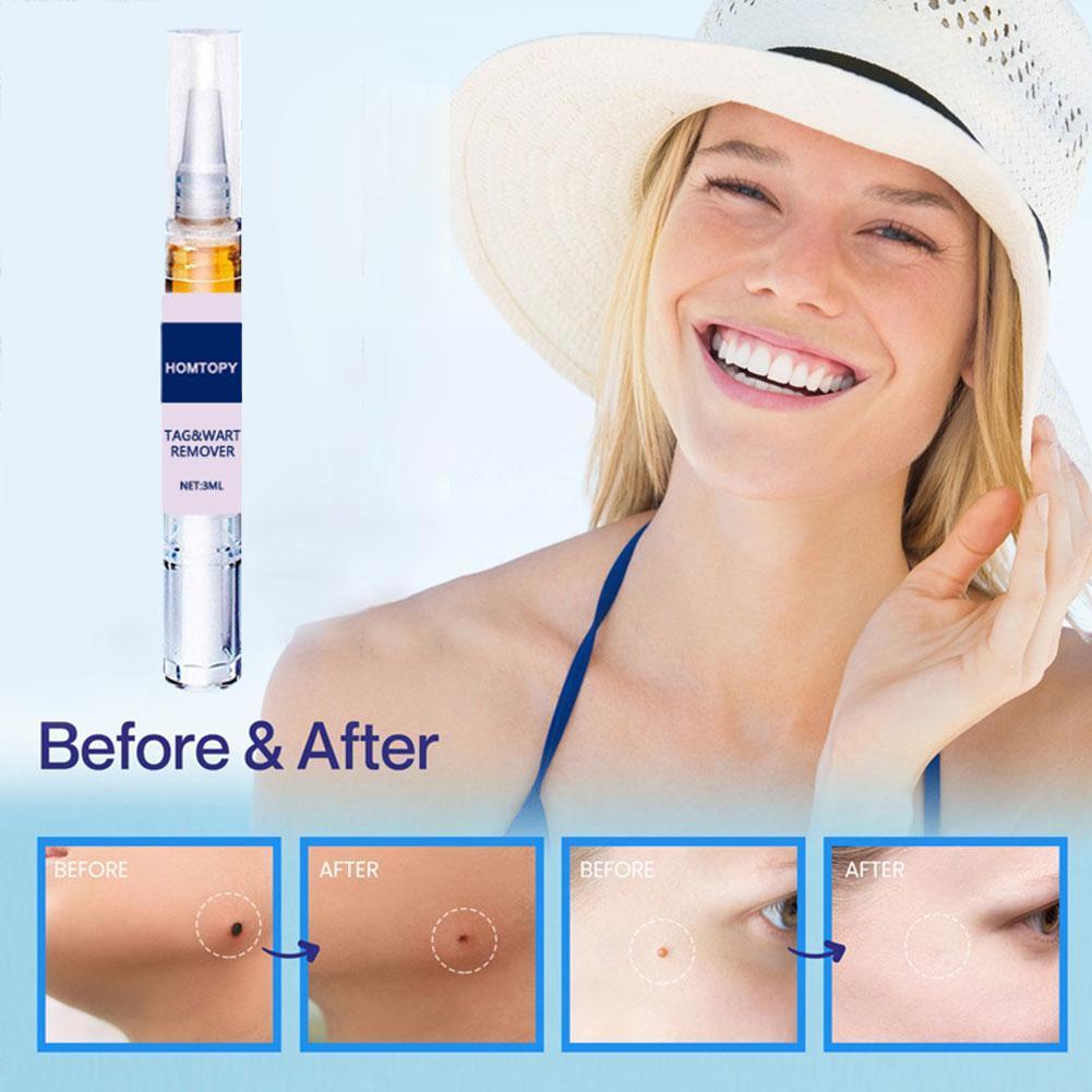 Auto Skin Tag Remover Kit Wart Remover Pen Skin Tag Mole Face Wart Care Remover Remover Mole Stain Beauty Tools J7J6