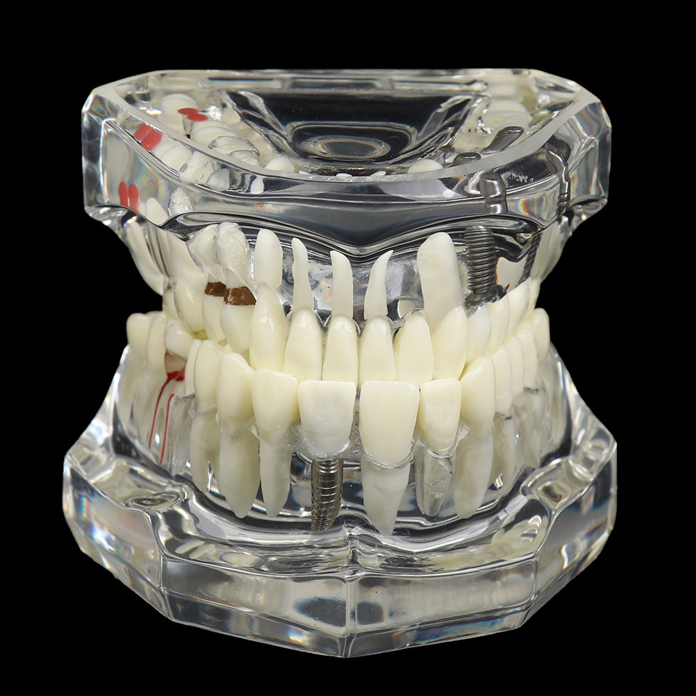 Dental Detachable Dental Restoration Model Pathological Dental Glass Teaching Implant Movable Dental Model Health Care Model