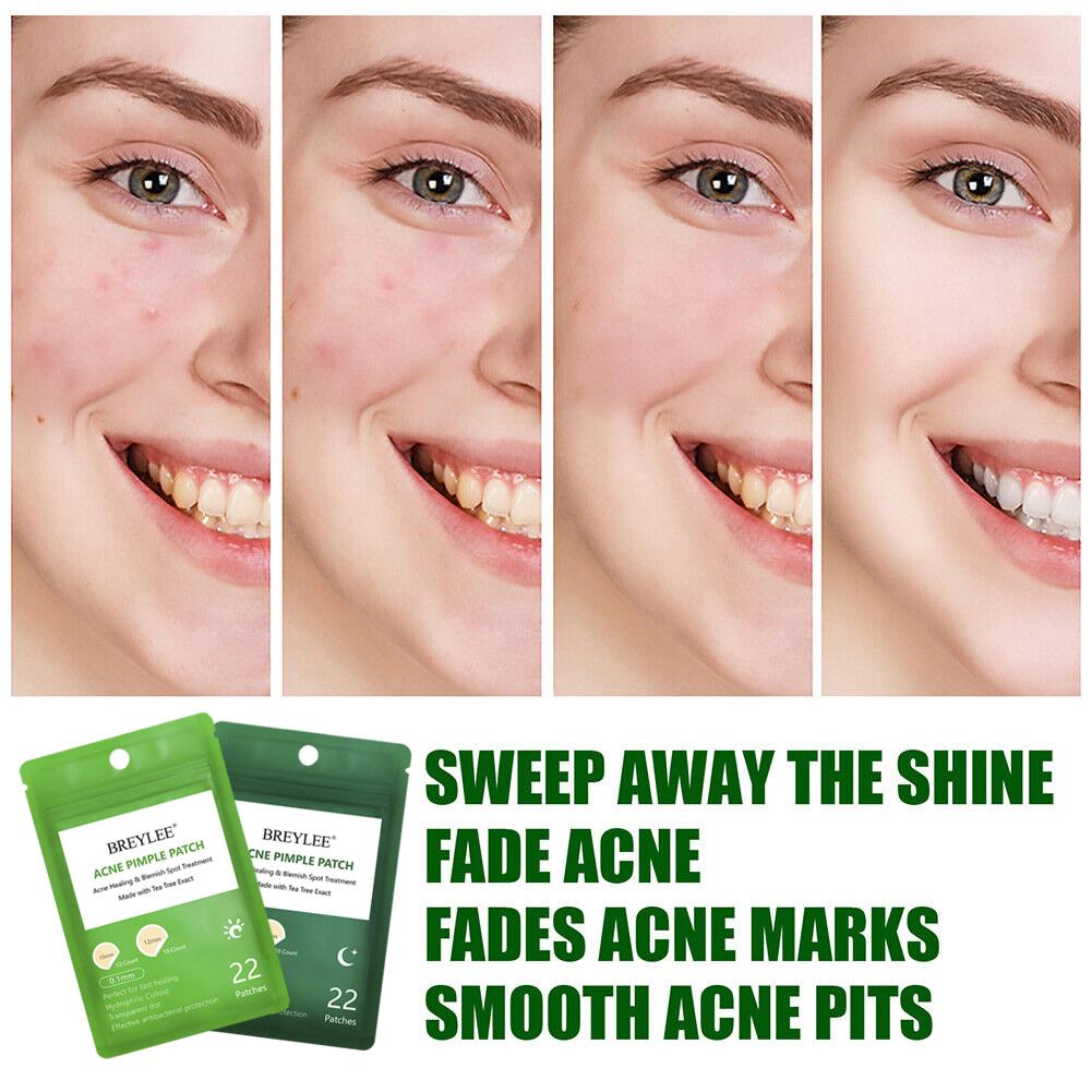 0.1mm Natural Tea Tree Acne Pimple Patch Stickers Waterproof Night Tools Care Blemish Mask Day Facial Skin Use Spot and T6A1